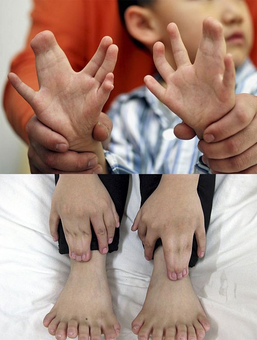 منداڵێك سی پەنجەی هەیە